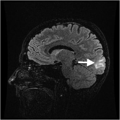 Posterior Reversible Encephalopathy Syndrome in the Emergency Department: Case Series and Literature Review