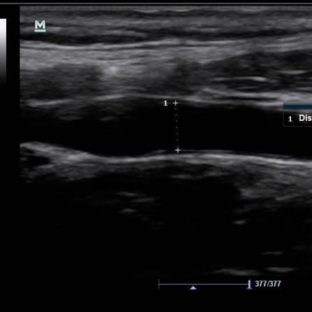 Emergency Ultrasound Identification of a Cornual Ectopic Pregnancy ...