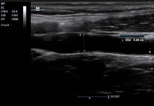 Can Emergency Physicians Perform Common Carotid Doppler Flow Measurements to Assess Volume Responsiveness?