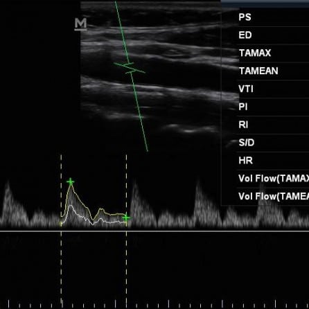 carotid doppler