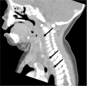 Descending Necrotizing Mediastinitis in an Infant - The Western Journal ...