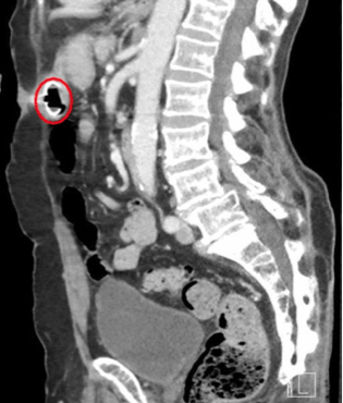Silent Killer: Case Report of Acute Gastrostomy Tube Erosion