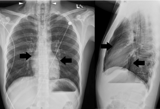 Spontaneous Pneumomediastinum on Bedside Ultrasound: Case Report and Review of the Literature