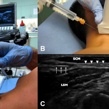 Ultrasound-guided Intraarticular Hip Injection for Osteoarthritis Pain ...