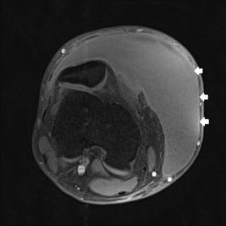 Morel-Lavallee Lesion Initially Diagnosed as Quadriceps Contusion ...