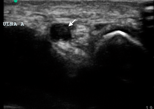 Point-of-care Ultrasound to Identify Distal Ulnar Artery Thrombosis: Case of Hypothenar Hammer Syndrome