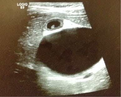 Choledochal Cyst Mimicking Gallbladder with Stones in a Six-Year-Old with Right-sided Abdominal Pain