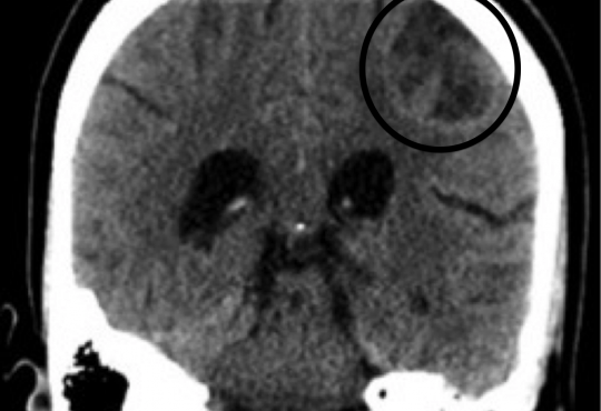 Open Ring Sign Diagnostic of Multiple Sclerosis in the Emergency Department