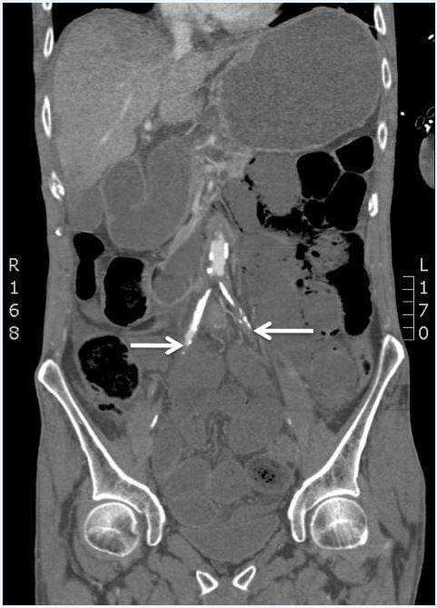 Leriche Syndrome Presenting with Multisystem Vaso Occlusive