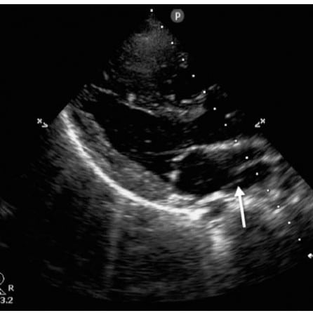 Ultrasound-Guided Diagnosis and Aspiration of Subdeltoid Abscess from ...