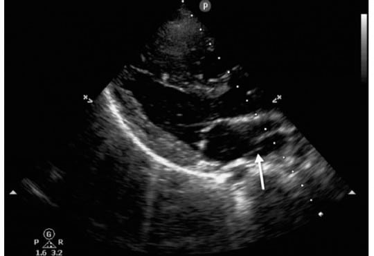 Focused Cardiac Ultrasound Diagnosis of Cor Triatriatum Sinistrum in Pediatric Cardiac Arrest