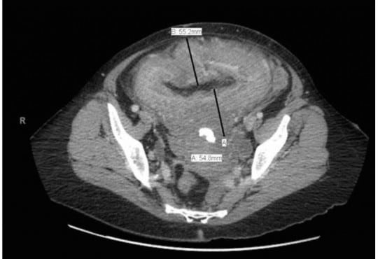 Bedside Ultrasound Evaluation Uncovering a Rare Urological Emergency Secondary to Neurofibromatosis