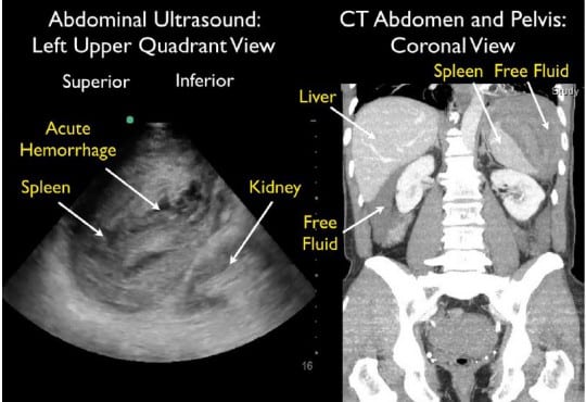 Splenic Rupture Diagnosed with Bedside Ultrasound in a Patient with Shock in the Emergency Department Following Colonoscopy