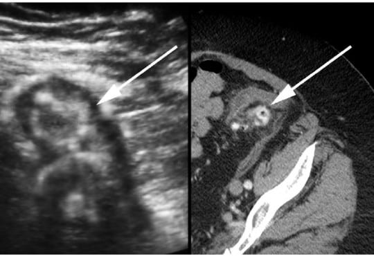 Elderly Woman with Abdominal Pain: Bedside Ultrasound Diagnosis of Diverticulitis