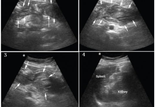 Ruptured Splenic Artery Aneurysm: Rare Cause of Shock Diagnosed with Bedside Ultrasound