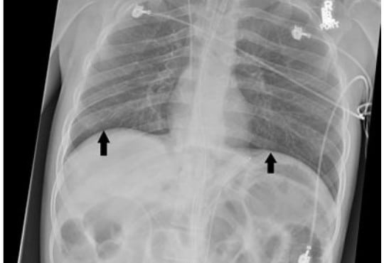 Tension Pneumoperitoneum Caused by Obstipation
