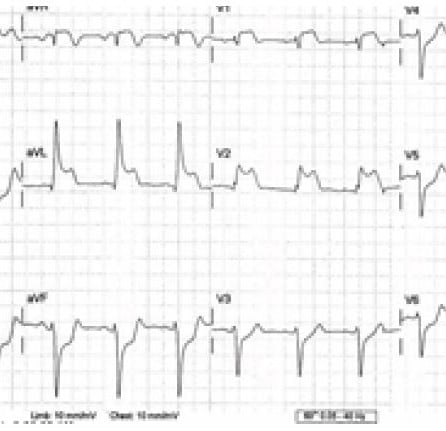 Fracture Blisters - The Western Journal of Emergency Medicine