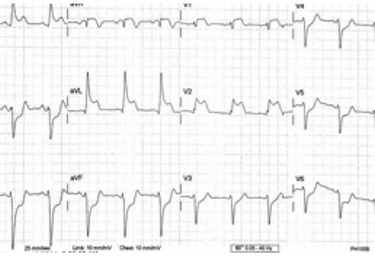 ST-Elevation Myocardial Infarction After Sumitriptan Ingestion in Patient with Normal Coronary Arteries