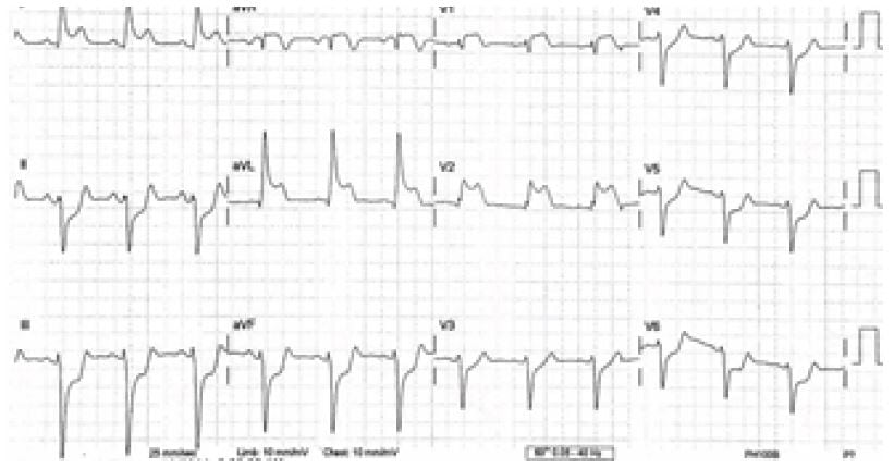 ST-Elevation Myocardial Infarction After Sumitriptan Ingestion in ...