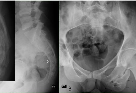 A Surprising Finding of Remote Ischial Avulsion