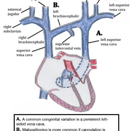 Ultrasound-Guided Cannulation: Time to Bring Subclavian Central Lines ...