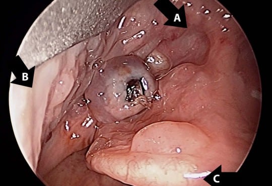 Vallecular Varix: A Perplexing Cause of Oral Cavity Bleeding