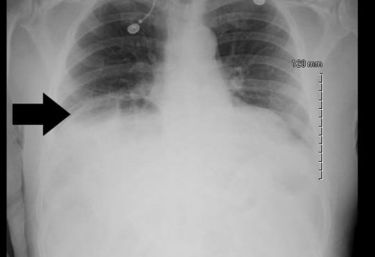 Chilaiditi Sign: Rare Incidental Finding on Chest Radiograph