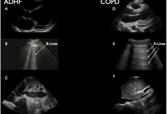 Point-of-Care Multi-Organ Ultrasound Improves Diagnostic Accuracy in Adults Presenting to the Emergency Department with Acute Dyspnea