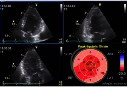 Strain Echocardiography in Acute Cardiovascular Diseases