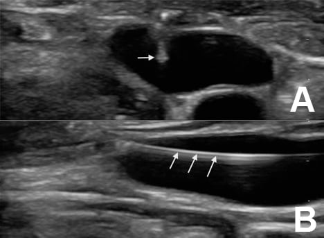 Seldinger Technique for Placement of “Peripheral” Internal Jugular Line: Novel Approach for Emergent Vascular Access