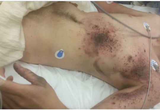 Electronic Vapor Cigarette Battery Explosion Causing Shotgun-like Superficial Wounds and Contusion