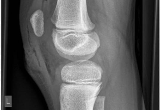 Traumatic Arthrotomy with Pneumarthrosis on Plain Radiograph of the Knee