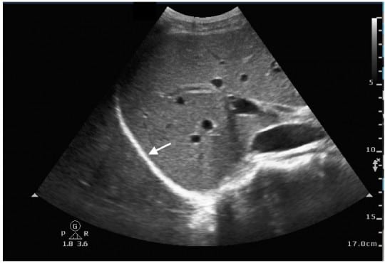 Young Woman with a Fever and Chest Pain