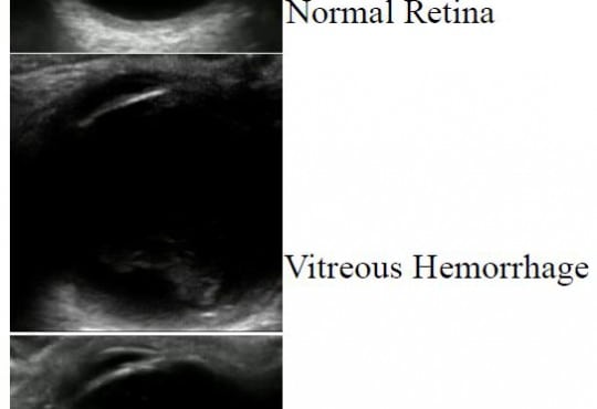 Retrospective Review of Ocular Point-of-Care Ultrasound for Detection of Retinal Detachment